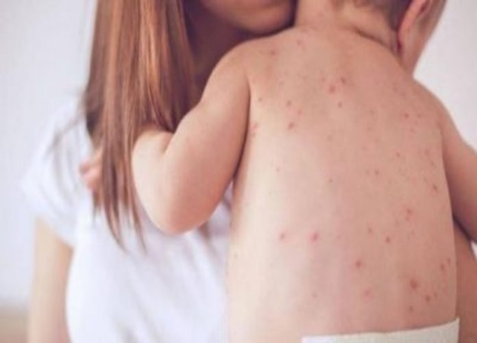 Cause Of Rubella (German Measles) In Kids