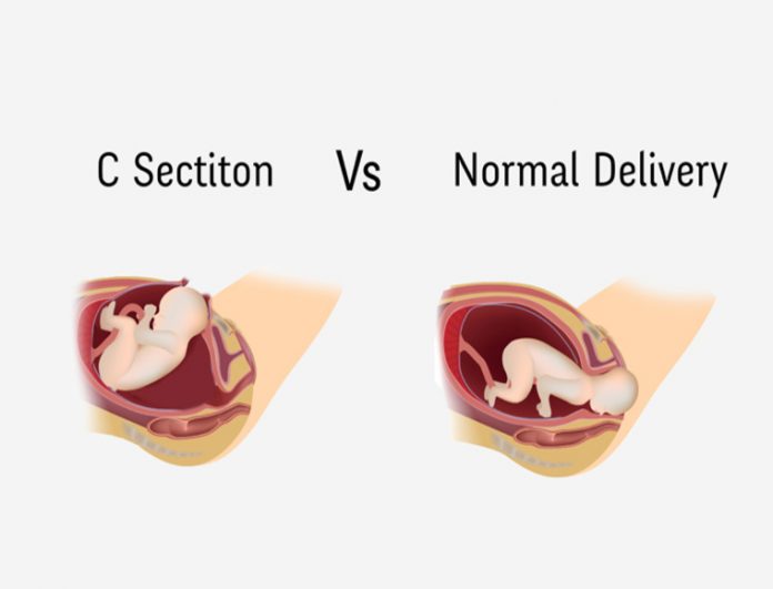 C-Section-Vs-Normal-Delivery