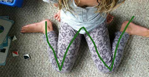 Effects Of W-Sitting Position In Toddlers